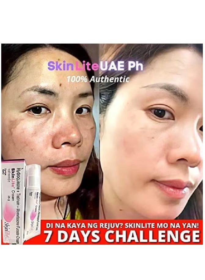 Skinlite Hydroquinone Tretinoin Mometasone Furoate Cream